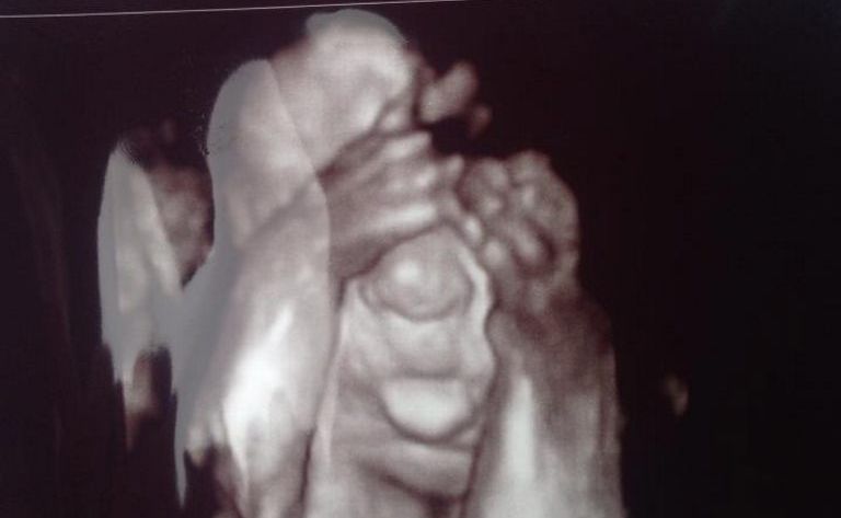 Hervey Bay's Jess Jeffery was delighted to see her baby girl Layla during a 4D scan. Hervey Bay's Jess Jeffery was delighted to see her baby girl Layla during a 4D scan.